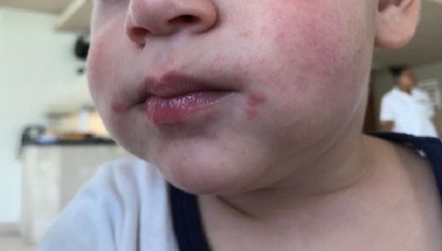 Enfermedad de manos, pies y boca, contagiosa y frecuente en niños