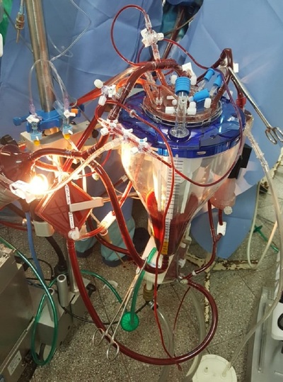 Cirugía cardiaca compleja con innovadora técnica