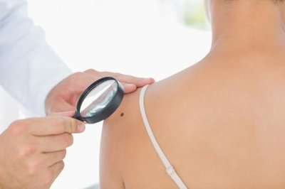 Impulsan "Campaña Solar 2019" para prevenir el cáncer de piel