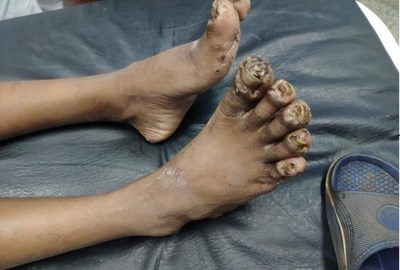 Rescatan a niño indígena con los pies y manos carcomidos por piques. Tiene una severa desnutrición