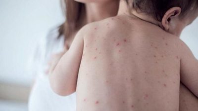 Vacuna contra el sarampión disponible en servicios de salud y es gratuita